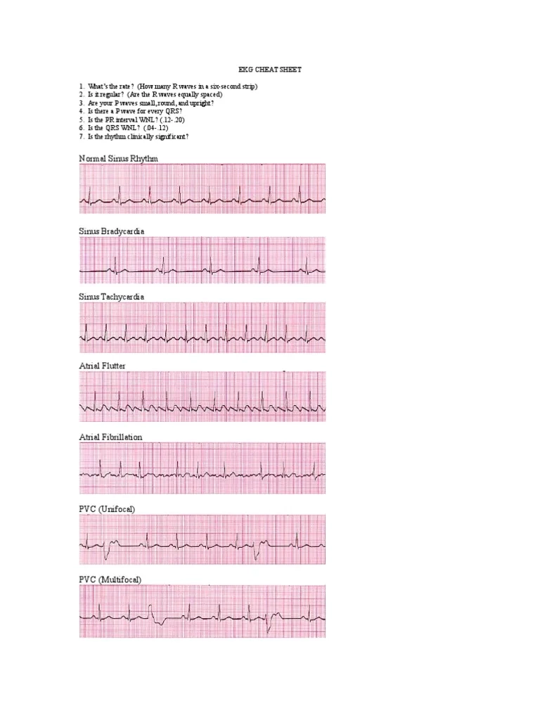 Ekg Cheat Sheet PDF